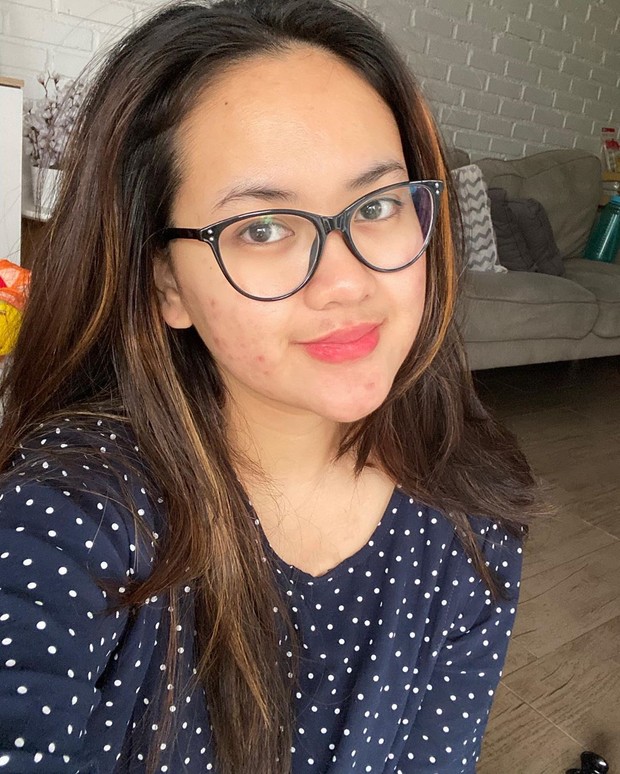 Selebgram yang juga menekuni dunia bisnis ini sering mengalami breakout pada wajahnya yang ditandai dengan jerawat meradang dan memerah. Namun hal tersebut tidak menjadikannya minder.