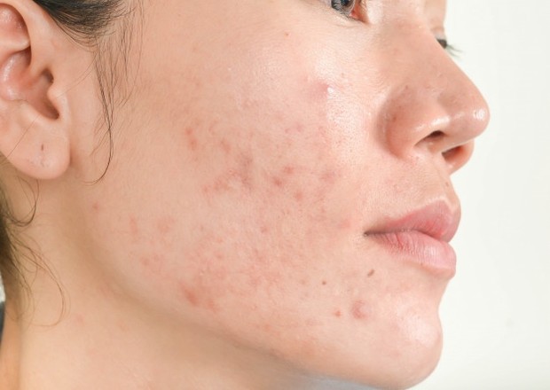 Masalah Jerawat/ Sumber: Freepik.com Acne patch dapat menjadi solusi instan untuk mengatasi masalah jerawat ringan.
