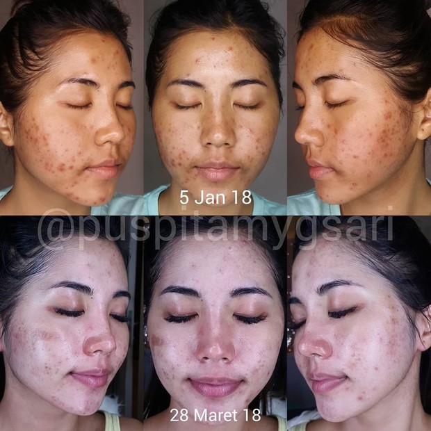 Puspi menjawab permasalahan tersebut melalui kanal YouTube-nya dengan memberikan tips makeup untuk menutupi jerawat.