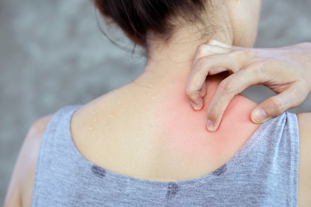 Kulit yang infeksi bisa berakibat aroma tubuh jadi tak sedap