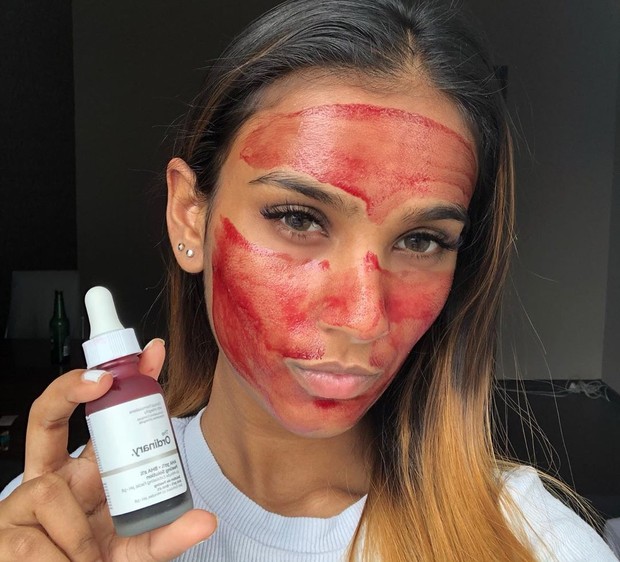 Aplikasikan The Ordinary Peeling Solution pada wajah yang sudah dibersihkan dan dalam keadaan kering demi menghindari lecet, lalu bilas setelah 10 menit hingga bersih.