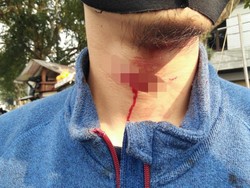 Tersabet Benang Layangan, Pemotor di Cimahi Luka di Leher