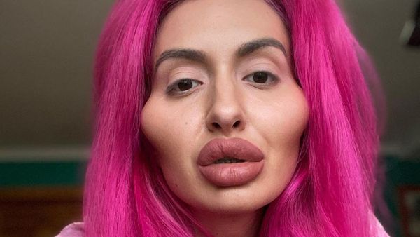 Foto: Wanita Berwajah Aneh karena Kebanyakan Filler Pipi