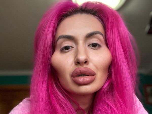 Foto: Wanita Berwajah Aneh karena Kebanyakan Filler Pipi