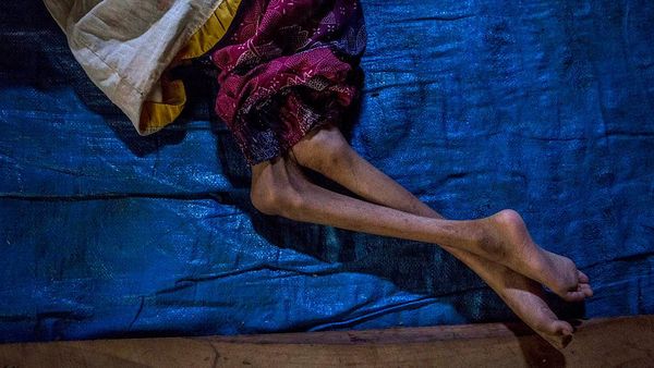 Corona Berisiko Tingkatkan Masalah Gizi Pada Anak