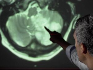 COVID-19 Sebabkan Otak Menyusut