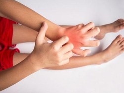 World Allergy Week, Yuk, Cegah Alergi yang Biasa Terjadi Pada Anak