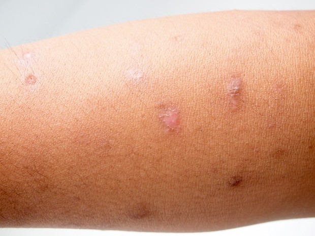 Untuk meminimalkan risiko munculnya jaringan parut, tutupi luka bakar sampai sembuh dengan kulit baru.