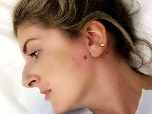 Dampak paling buruk yang ditimbulkan dari penggunaan krim pemutih berbahan bahaya adalah kanker kulit.