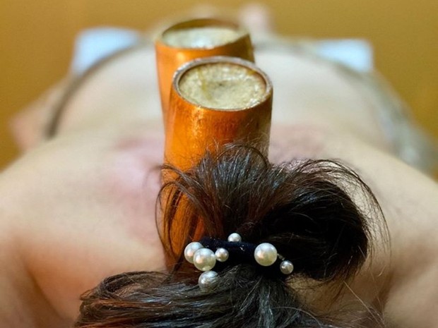 Terapi Bekam/ Foto: instagram.com/amalfitanoclinic manfaat bekam di antaranya dapat mengatasi varises dan spider veins