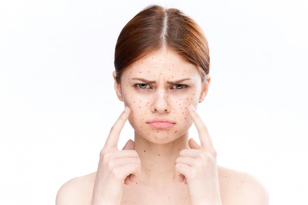 Ilustrasi bekas bekas jerawat