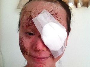 Gunakan Steroid untuk Obati Eczema, Wajah Wanita Ini Berakhir Hancur