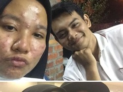 Uwu...Viral Cerita Pria Setia Dampingi Pacarnya dari Jerawatan Hingga Mulus
