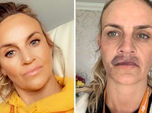 Gagal Filler Bibir di Rumah, Wanita Ini Berakhir Jadi Seperti Punya Kumis