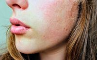 Fakta-Fakta Tentang Fungal Acne Dan Cara Menyebuhkannya