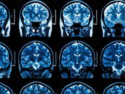 Virus Corona Bisa Memicu Kerusakan Parah pada Otak