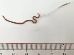 Eks Pejabat WHO Ikut Soroti Kasus Cacingan di Balita Sukabumi, Wanti-wanti Ini