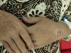 Cerita Keji Penyiksaan TKI di Arab Saudi oleh Majikan Perempuan