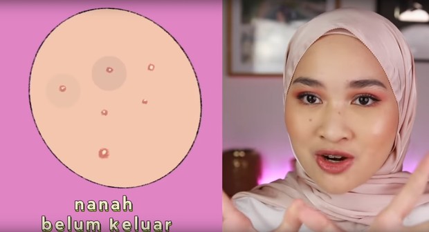 gunakan acne patch saat nanah jerawat sudah keluar