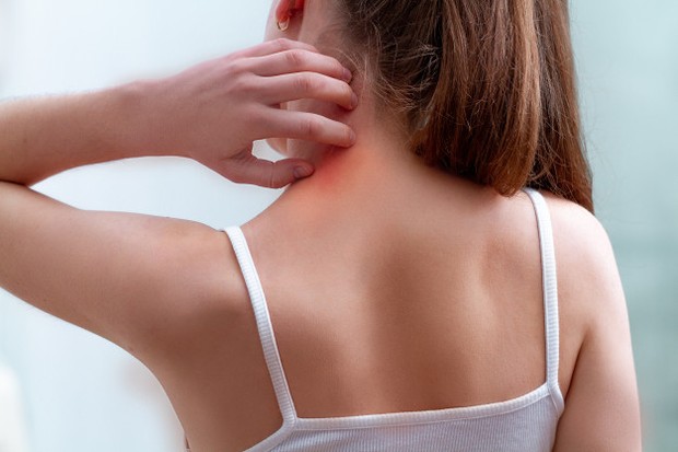 eksim dapat menyebabkan kulit kepala gatal