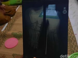 Begini Kondisi Bocah 8 Tahun yang Dihajar Tetangga hingga Pendarahan Otak