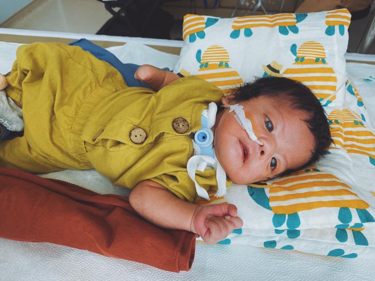 Hiro, bayi yang alami Moebius syndrome