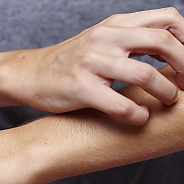 Ada beberapa faktor yang menyebabkan dermatitis atau eksim