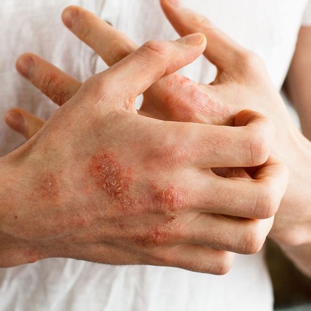 Ada ebberapa cara yang bisa meredakan gejala dermatitis