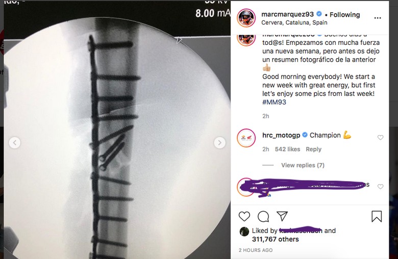 Cedera patah tulang Marc Marquez