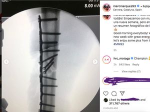 Ngilu Banget, Before-After Kondisi Patah Tulang Marc Marquez