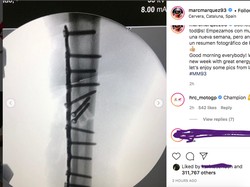 Ngilu Banget, Before-After Kondisi Patah Tulang Marc Marquez