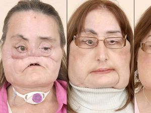 9 Tahun Bertahan Hidup, Pasien Transplantasi Wajah Pertama AS Meninggal 9 Tahun Bertahan Hidup, Pasien Transplantasi Wajah Pertama AS Meninggal