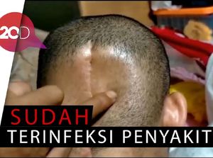 Kanker Otak, Sebagian Tempurung Kepala Istri Reza Dibuang