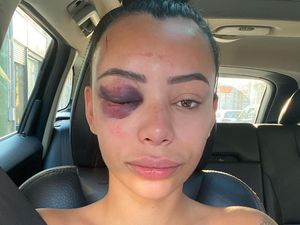 Wajah Cantik Bintang Reality Show Babak Belur Setelah Dipukuli di Pesta