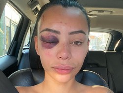 Wajah Cantik Bintang Reality Show Babak Belur Setelah Dipukuli di Pesta