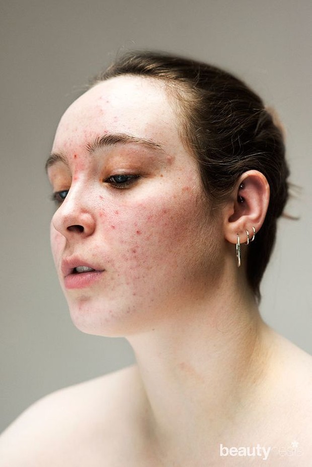 Jika memakai Vitamin C dan Retinol maka akan iritasi khususnya orang kulit sensitif.