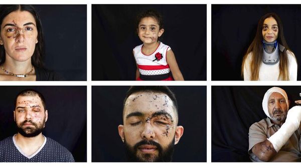 Potret Korban Luka Akibat Ledakan Lebanon