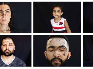 Potret Korban Luka Akibat Ledakan Lebanon