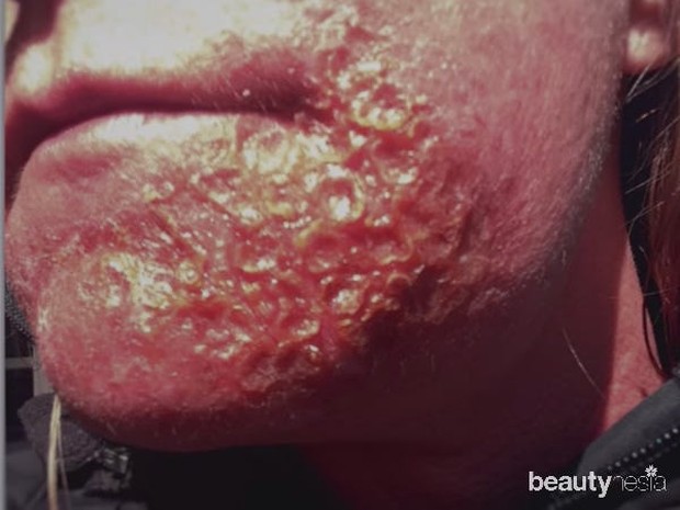 Stacey Haluka alami ruam parah akibat meminum essential oil