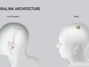 Ilmuwan Cemas Nasib Pasien Elon Musk yang Otaknya Ditanam Chip