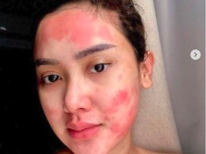 Wajah Cita Citata Dipenuhi Bercak Merah, Efek Pembengkakan Amandel 5 Tahun