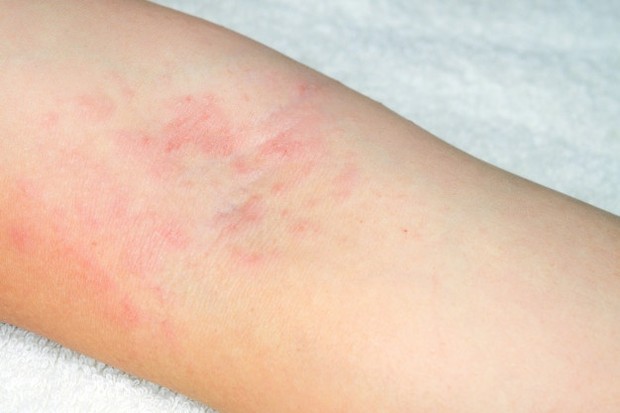 Moisturizer untuk Eksim/ Sumber: Freepik.com Gunakan moisturizer kulit setidaknya dua kali sehari. Temukan produk atau kombinasi produk yang sesuai untuk kulitmu.