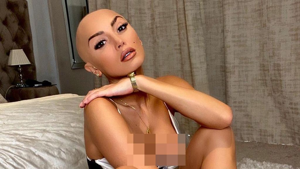 Foto Bintang Reality TV Cantik Alami Alopecia, Dari Rambut Panjang Jadi Botak