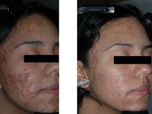 Wanita Ini Dulu Minder Jerawatan Lihat Sekarang Wanita Ini Dulu Minder Jerawatan Lihat Sekarang