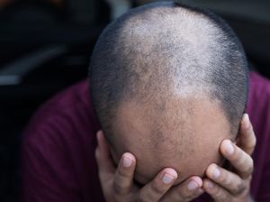 Pria Ini Malah Jadi Botak Gara-gara Terlalu Semangat Olahraga