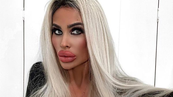 Foto: Wanita yang Disebut Mirip Boneka Seks Setelah Implan Payudara 5 Kali