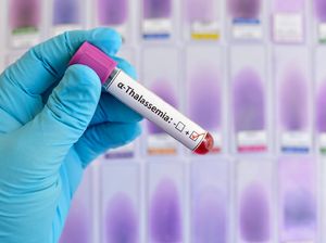 Bunda! Kenali Gejala Thalassemia Pada Anak-anak Bunda! Kenali Gejala Thalassemia Pada Anak-anak