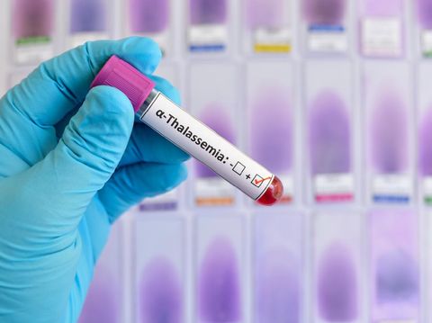 Blood sample positive with alpha-thalassemia