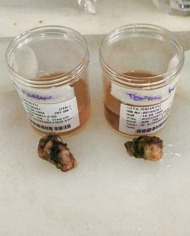 Cerita Cita Citata alergi kulit parah selama 5 tahun karena penyakit Streptococcus Tonsillitis.