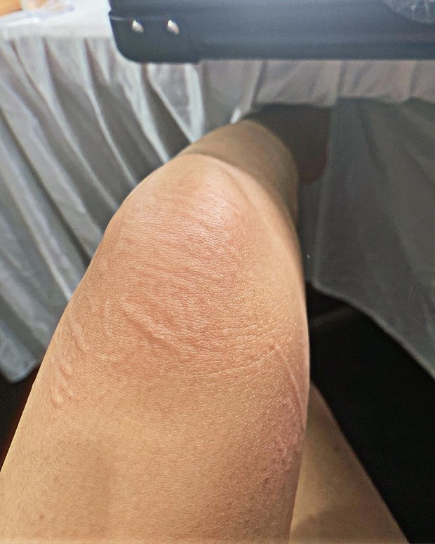 Cerita Cita Citata alergi kulit parah selama 5 tahun karena penyakit Streptococcus Tonsillitis.